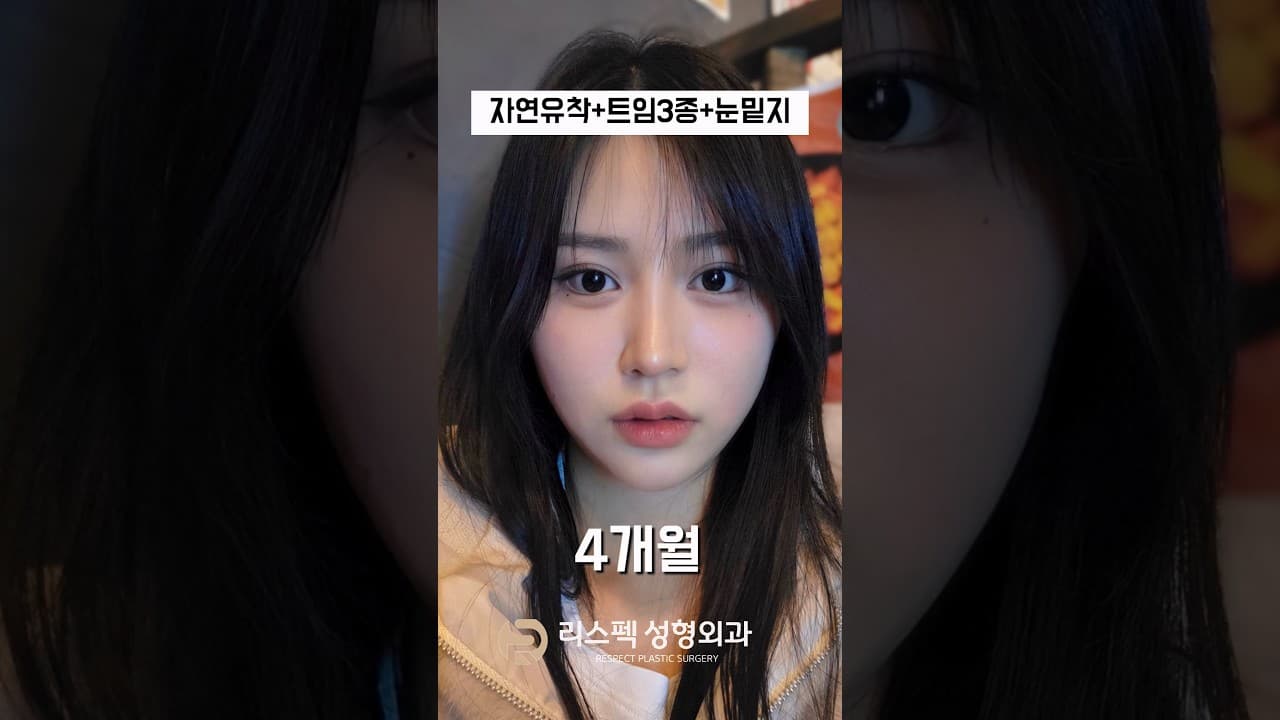 자연유착+트임3종+눈밑지방재배치 후기영상