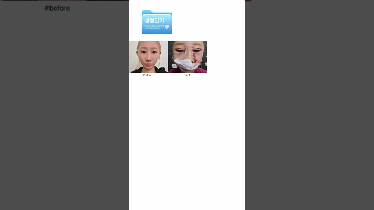 성형일기(1) 붓기 진짜 ㄹㅈㄷ 믿겨가 안 돼;;