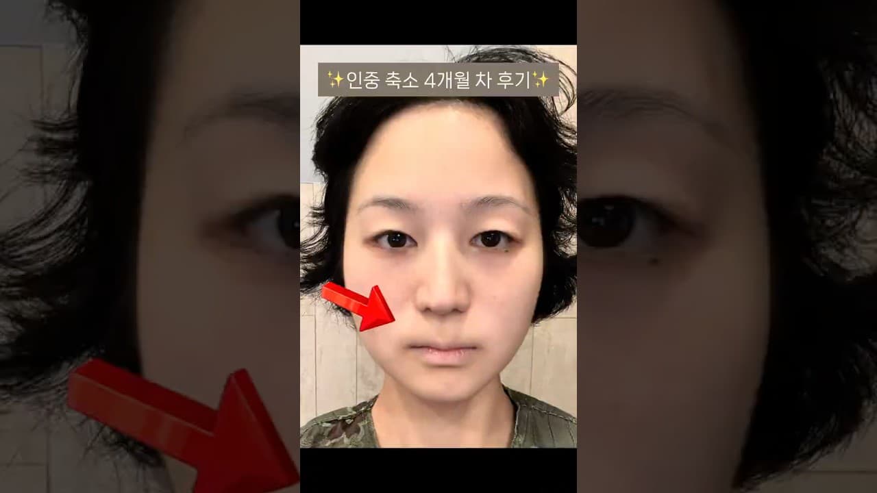 무봉합 인중축소+외측 인중축소+입꼬리+ 눈 절개 재수술+이마축소 받으셨습니다💗 #인중축소 #쌍수 #성형외과 #이마축소