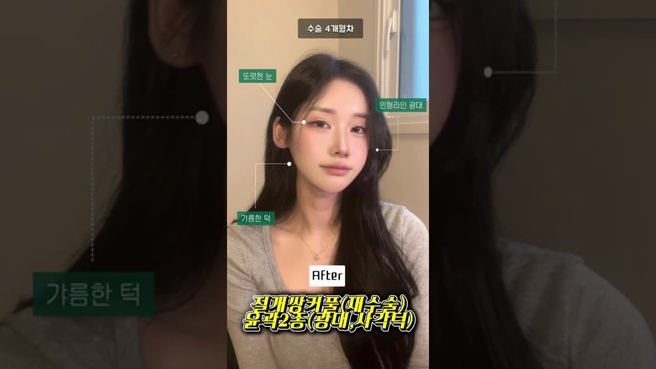얼굴 어디까지 작아지는 거예요? 🤭#윤곽수술 #리스펙성형외과