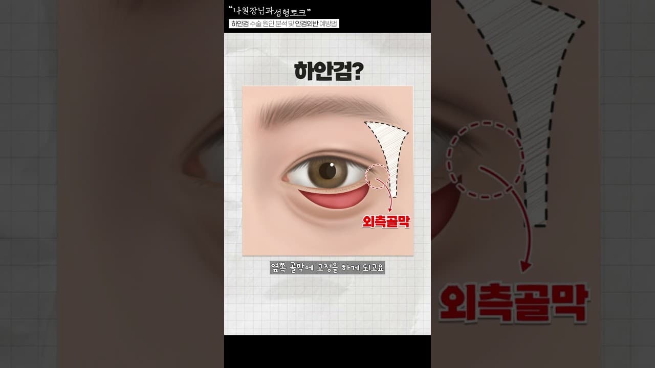 눈밑을 집처럼 리모델링한다? 하안검 수술 요약