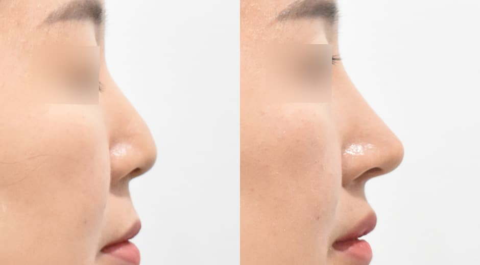 人中鼻(第一次手術) 縮短人中