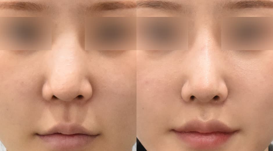 人中鼻(二次修復手術) 縮短人中