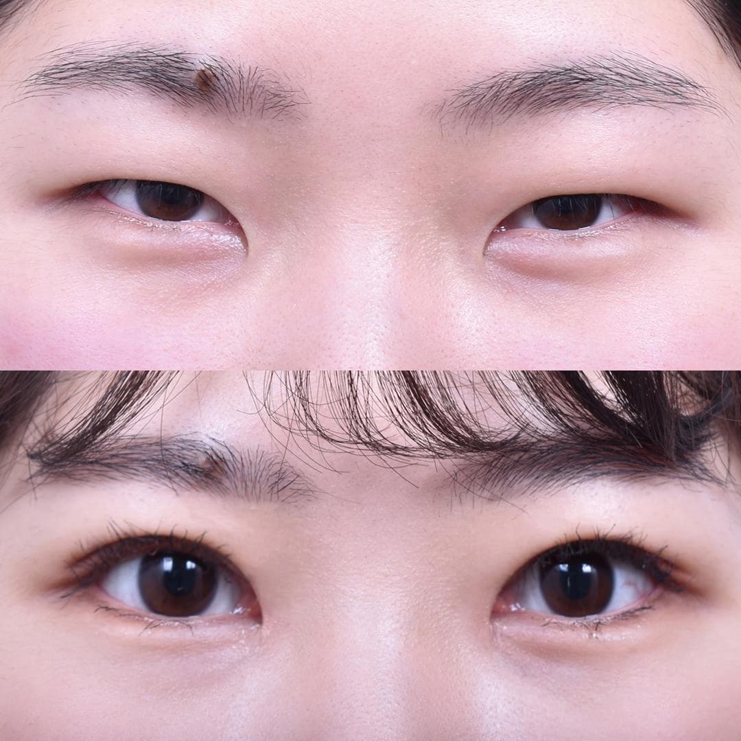 非切開眼型矯正 + 前眼角開大(1個月後)