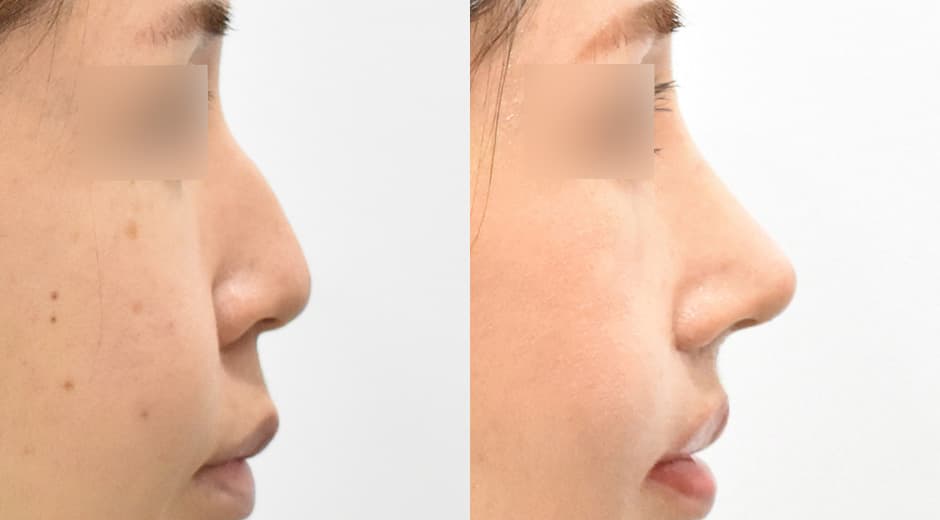 人中鼻(第一次手術) 縮短人中