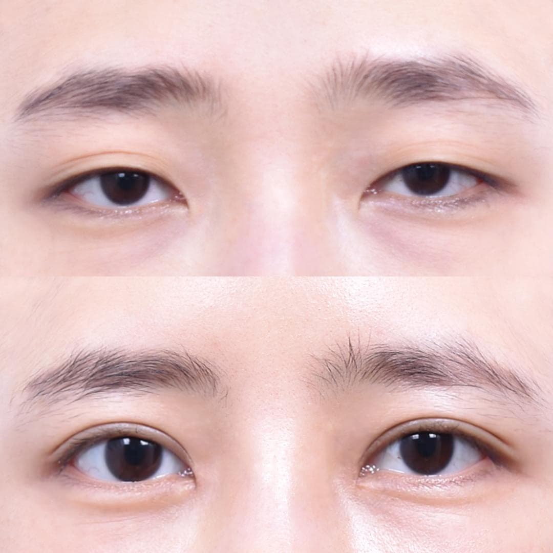 非切開眼型矯正 + 前眼角開大 + 上眼角開大(1個月後)