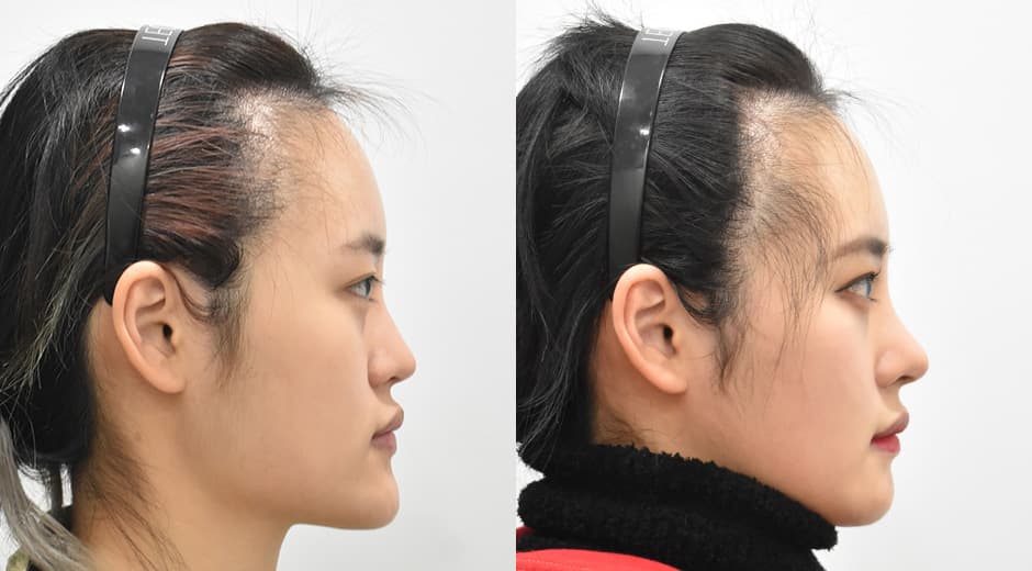 縮小方形下顎 縮小前下顎