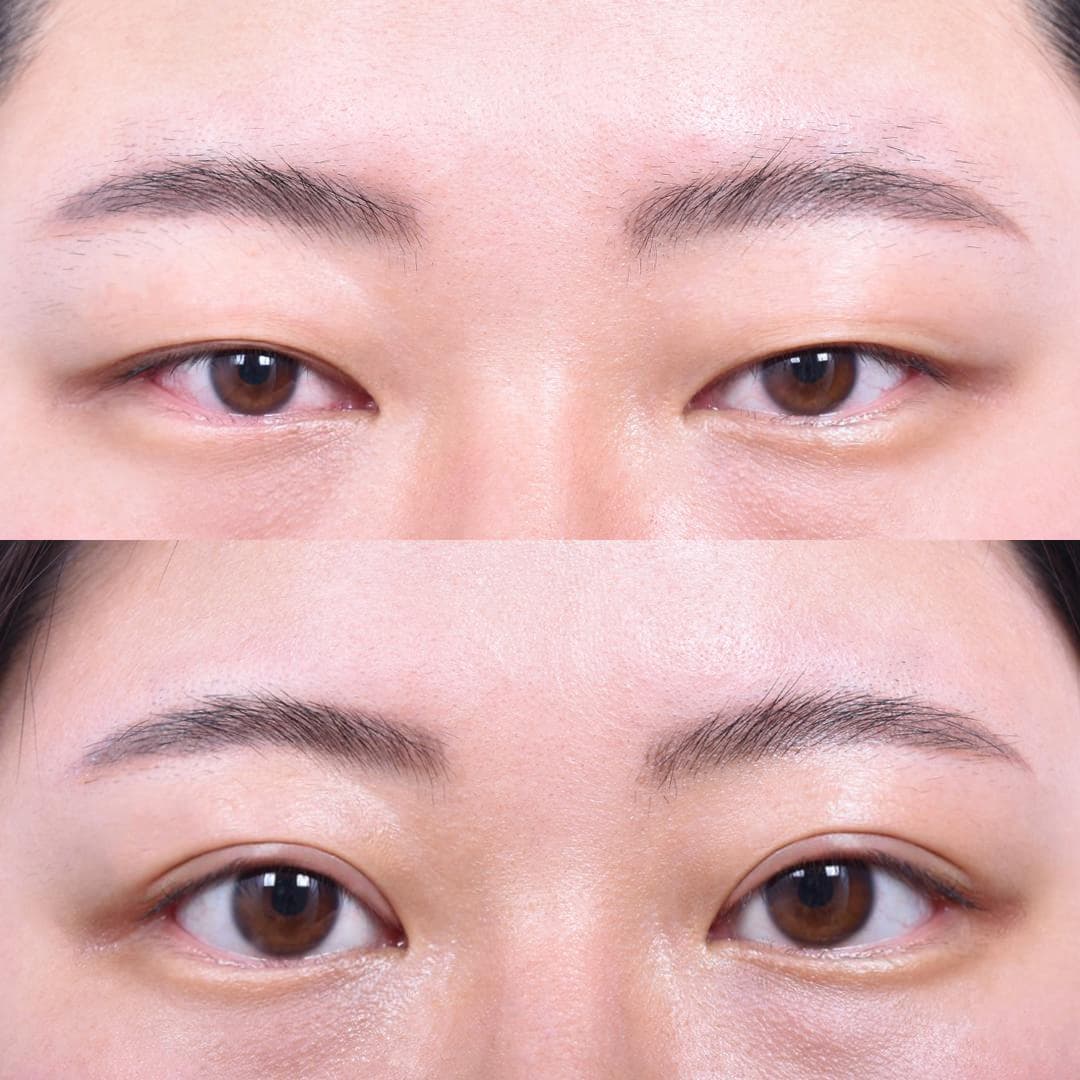 縫雙眼皮(1週後)