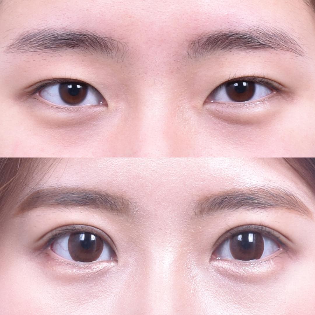 縫雙眼皮(1個月後)