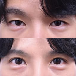 Eye Revision Surgery (3 Weeks Post-Op)