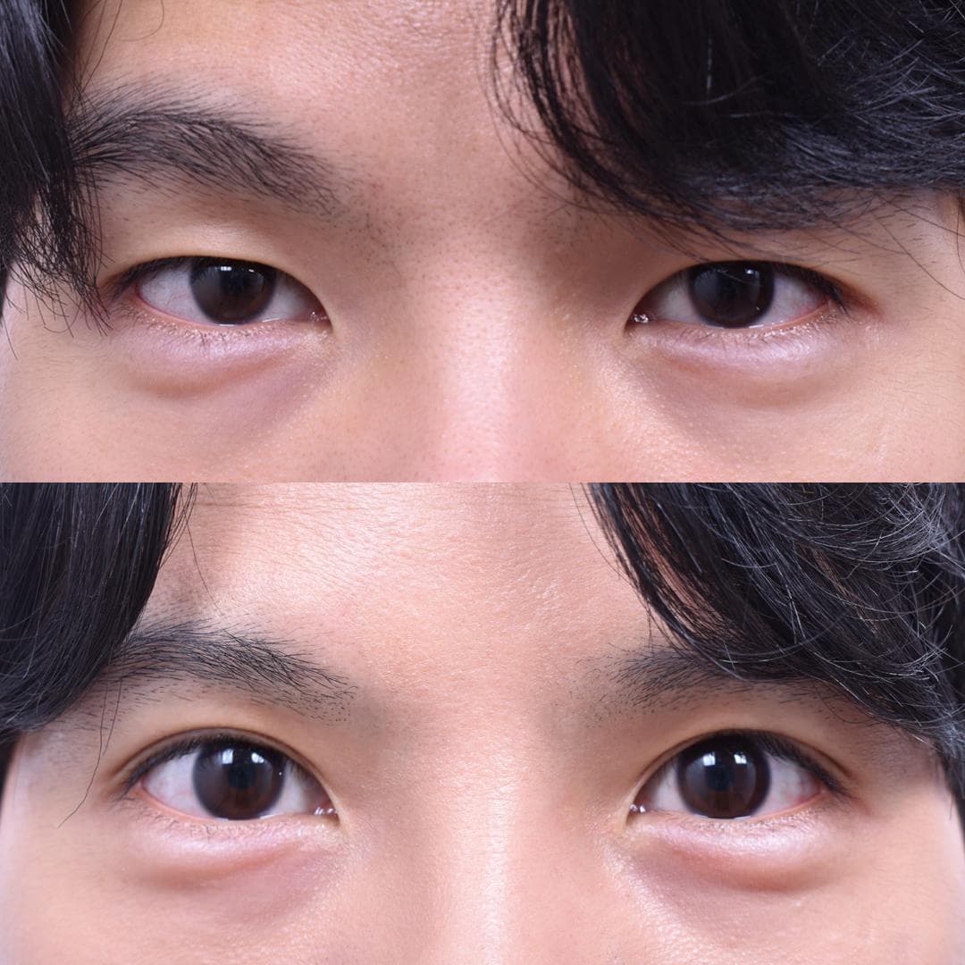 眼部二次手術(3週後)