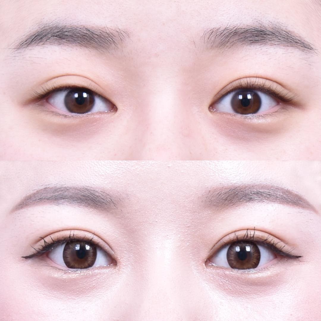 縫雙眼皮 + 前眼角開大(1個月後)