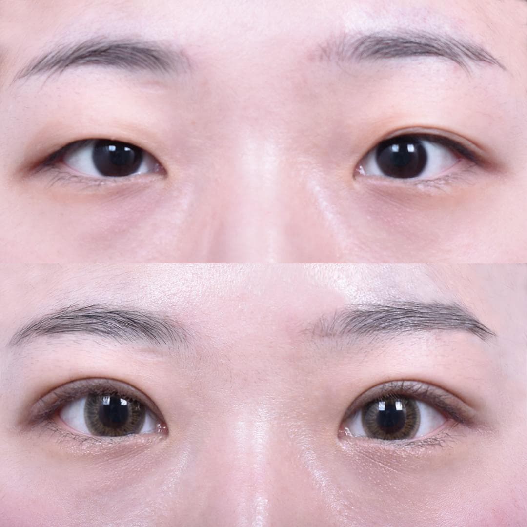 非切開眼型矯正 + 前眼角開大(1個月後)