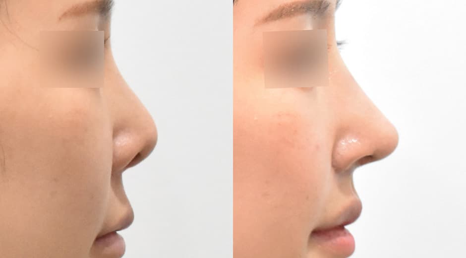 人中鼻(二次修復手術) 縮短人中